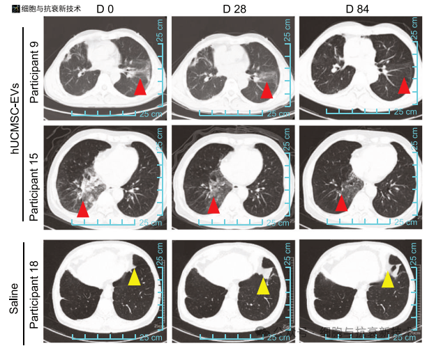 纖維化進程逆轉